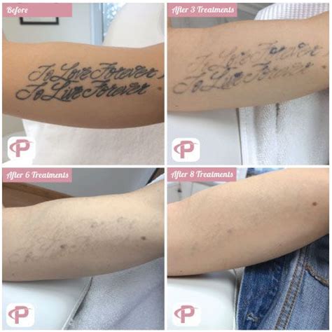 laser tattoo removal fading process.
